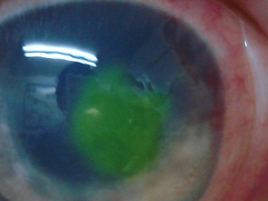 Ulcera corneal carlino